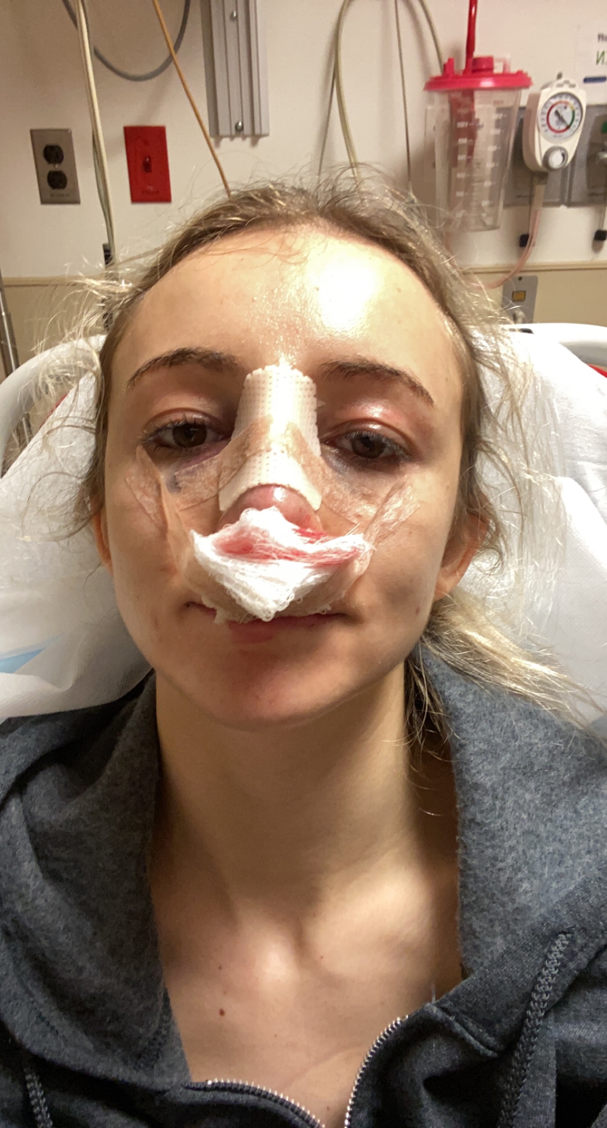 My Entire Rhinoplasty/Septoplasty Recovery – Day By Day