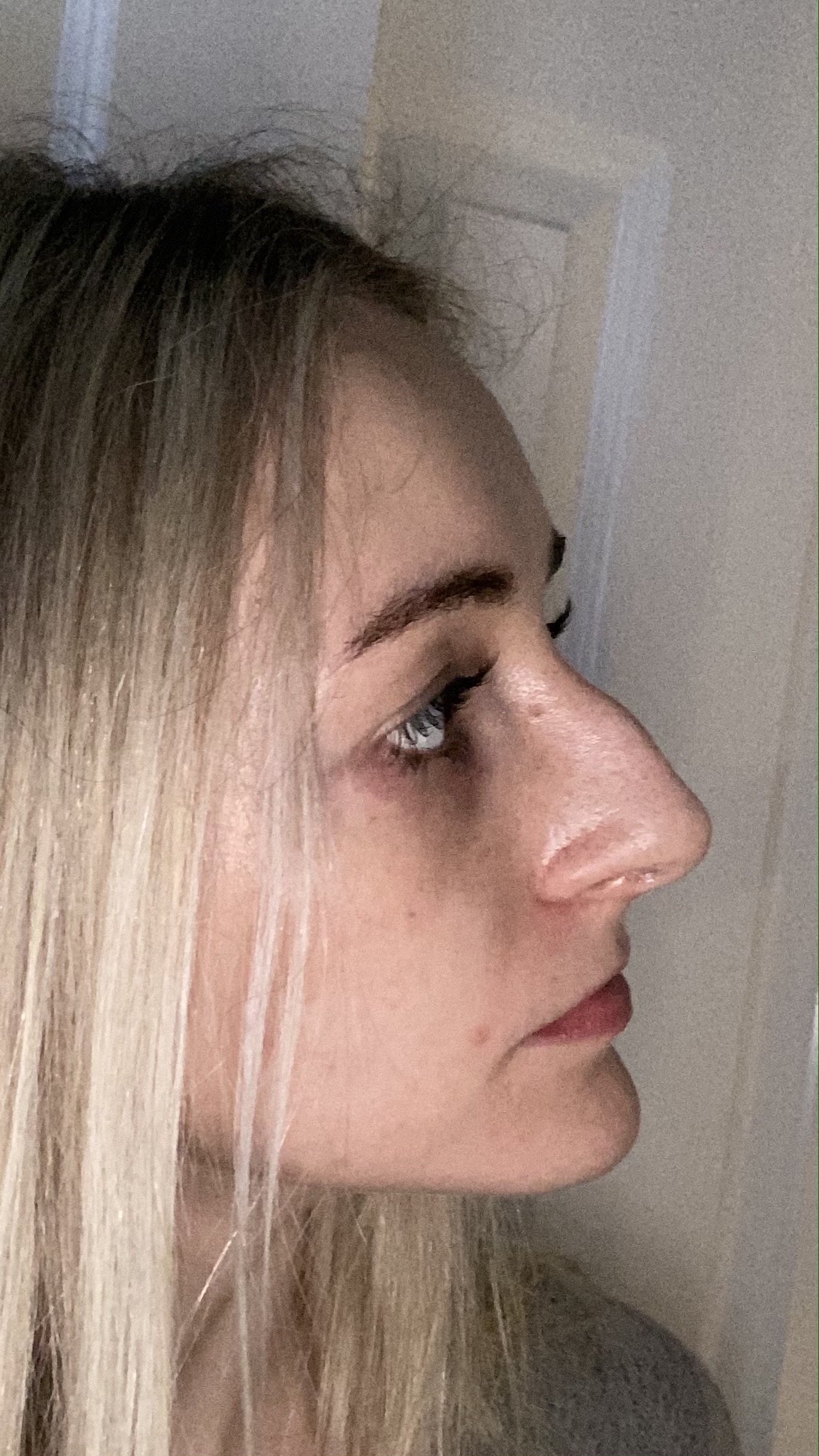 My Entire Rhinoplasty/Septoplasty Recovery – Day by Day